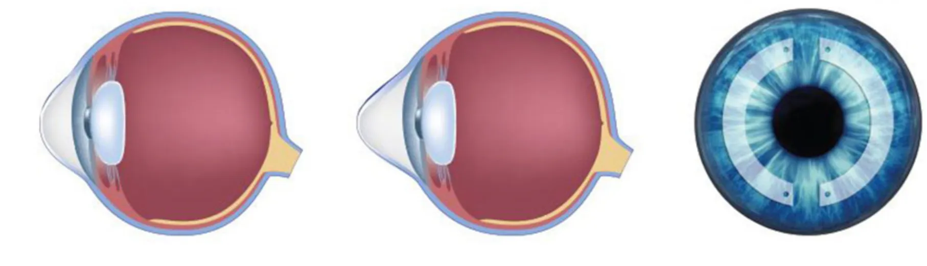 Dois olhos em corte, antes e depois do implante, com a córnea menos projetada, e uma vista de frente com os dois segmentos de anel ao redor da pupila.