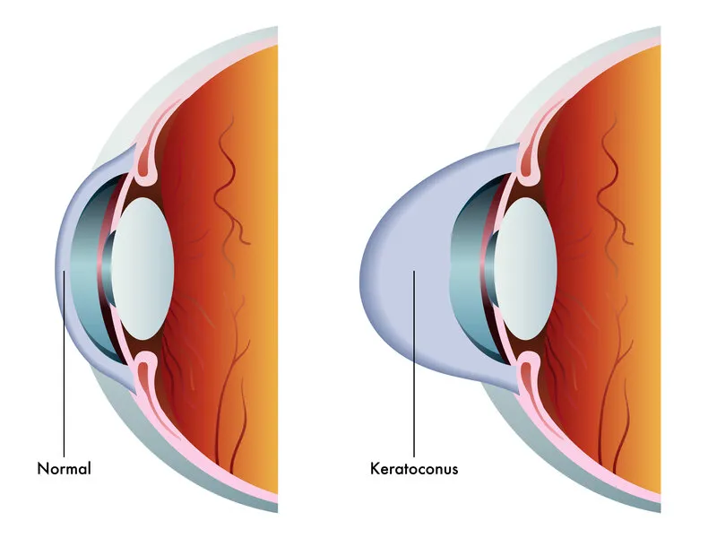 Comparação entre um olho normal e um olho com ceratocone, em que a córnea fica mais fina e projetada em forma de cone.