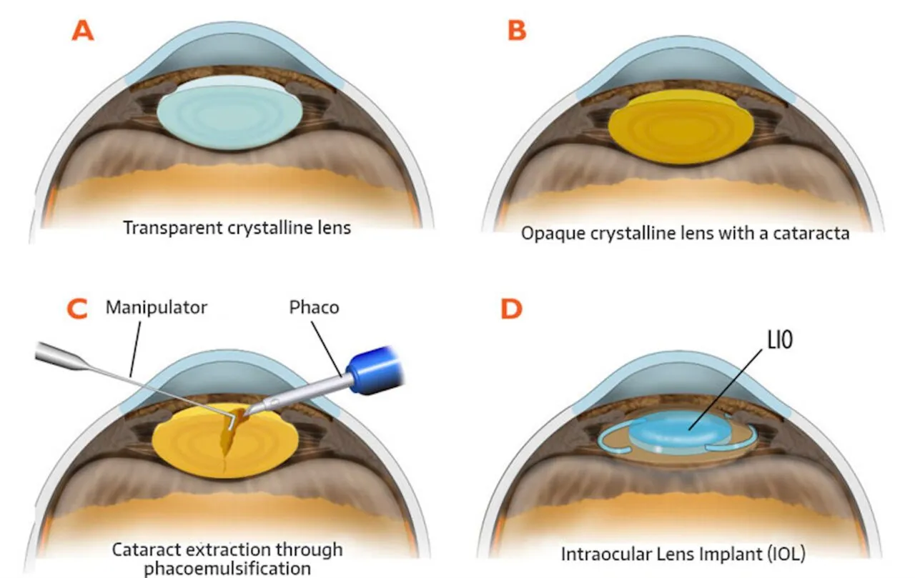 Quatro etapas ilustradas: cristalino transparente, cristalino opaco pela catarata, fragmentação e aspiração da catarata e lente intraocular implantada.