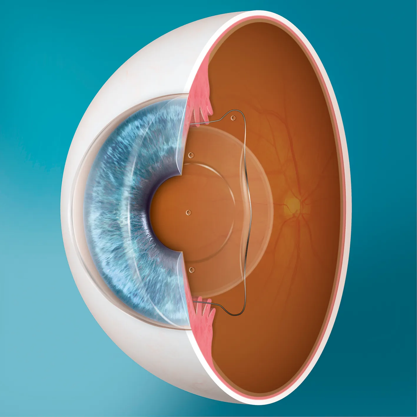 Ilustração de um olho em corte com uma lente fácica implantada atrás da íris.
