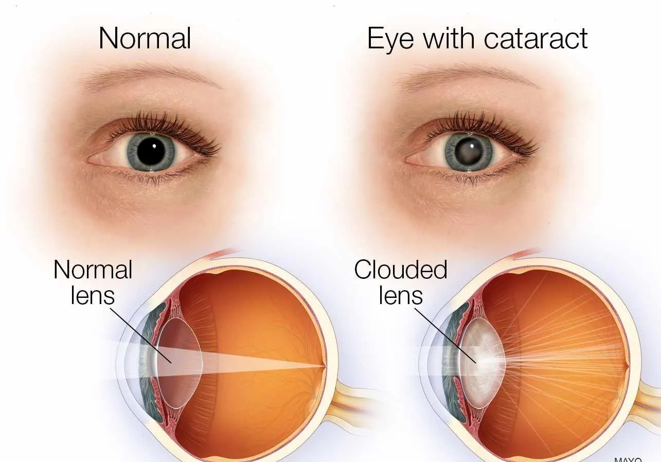 Comparação entre um olho normal e um olho com catarata, em que o cristalino opaco espalha a luz em vez de concentrá-la na retina.