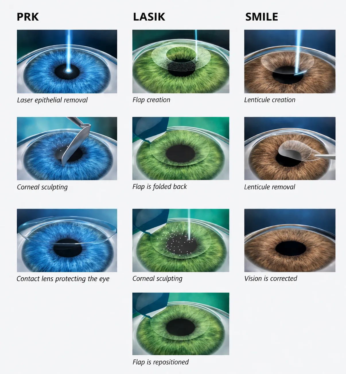 Quadro com as etapas do PRK, do LASIK e do SMILE, lado a lado.