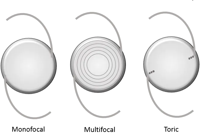 Três lentes intraoculares desenhadas lado a lado: monofocal, multifocal com anéis concêntricos e tórica com marcas de eixo.