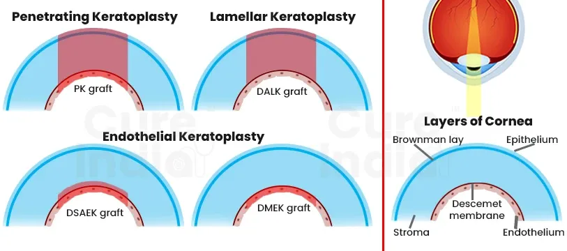 Quatro tipos de transplante de córnea em corte: penetrante, lamelar anterior (DALK) e dois endoteliais (DSAEK e DMEK), ao lado das camadas da córnea.