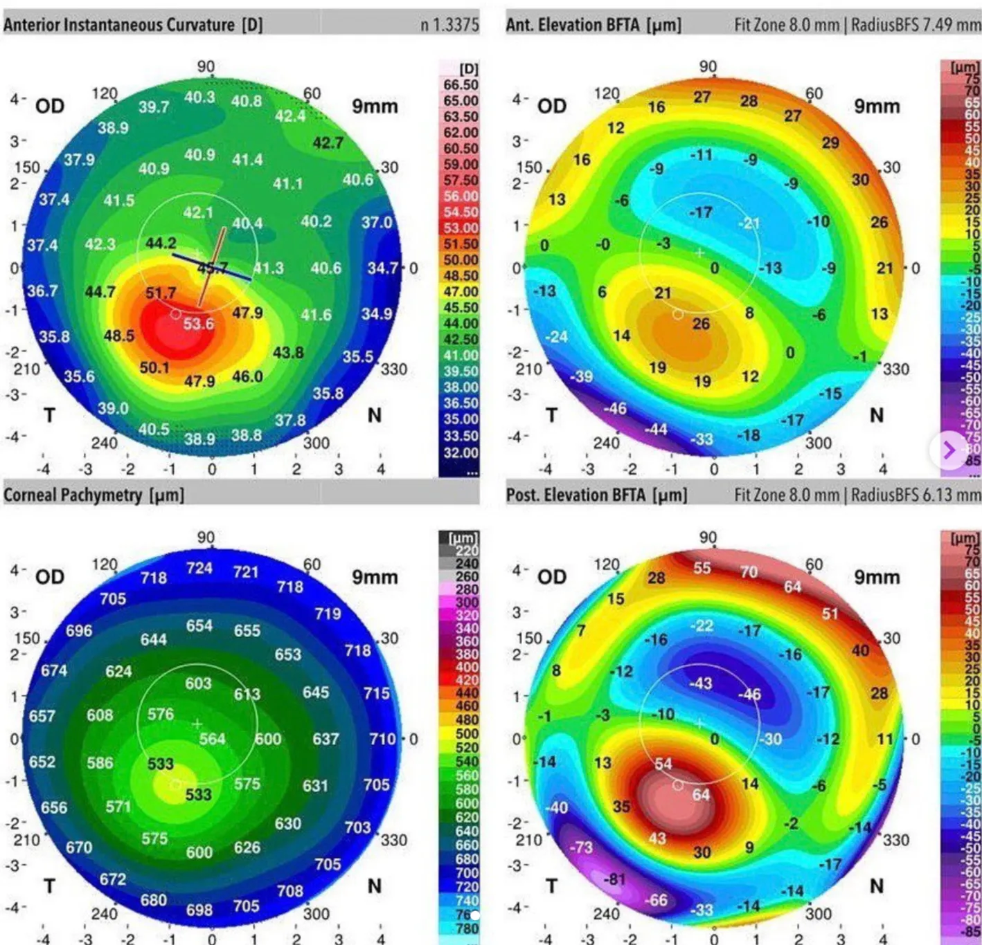 Quatro mapas coloridos de tomografia da córnea de um olho com ceratocone: curvatura, elevação anterior, espessura e elevação posterior.
