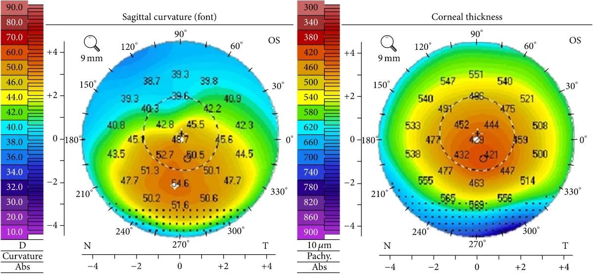 Dois mapas coloridos da córnea de um olho com ceratocone. No da esquerda, de curvatura, e no da direita, de espessura, as cores laranja e vermelha se concentram abaixo do centro.